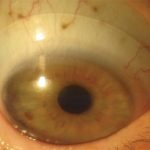 Lentes esclerales, el presente y el futuro de las lentes de contacto