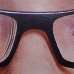¿Tus gafas te hacen parecer miope? Vuelve invisibles los aros de la miopía!!
